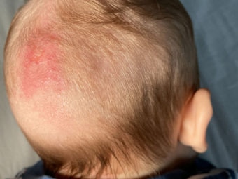Fungal Infection In Babies Risks, Treatment And Remedies